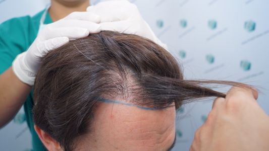 Injerto Capilar Técnica FUE 1916 Grafts (4597 Pelos) 12 DISEÑO LÍNEA INJERTO CAPILAR