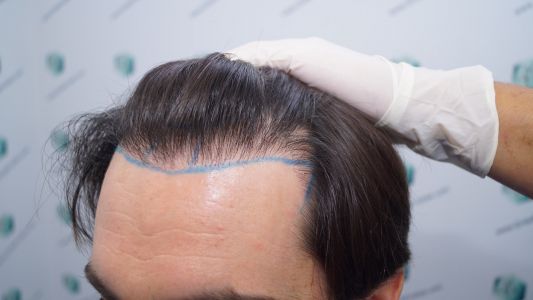 Injerto Capilar Técnica FUE 1916 Grafts (4597 Pelos) 13 DISEÑO LÍNEA INJERTO CAPILAR