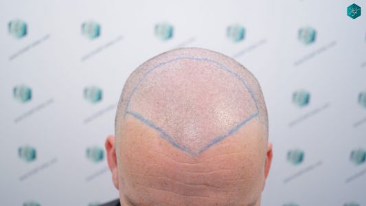 Injerto Capilar Técnica FUE 2759 Grafts (6049 Pelos) 10 DISEÑO LÍNEA INJERTO CAPILAR