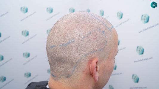 Injerto Capilar Técnica FUE 2759 Grafts (6049 Pelos) 11 DISEÑO LÍNEA INJERTO CAPILAR