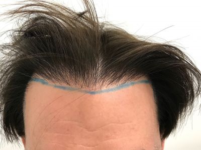 Injerto Capilar Técnica FUE 1916 Grafts (4597 Pelos) 15 DISEÑO LÍNEA INJERTO CAPILAR