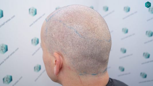 Injerto Capilar Técnica FUE 2759 Grafts (6049 Pelos) 12 DISEÑO LÍNEA INJERTO CAPILAR