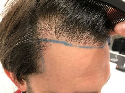 Injerto Capilar Técnica FUE 1916 Grafts (4597 Pelos) 16 DISEÑO LÍNEA INJERTO CAPILAR