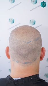 Injerto Capilar Técnica FUE 2759 Grafts (6049 Pelos) 13 DISEÑO LÍNEA INJERTO CAPILAR