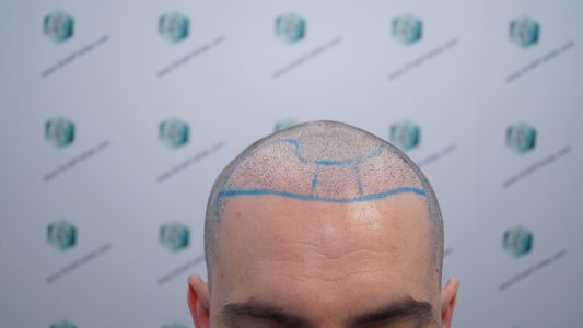 DISEÑO LÍNEA INJERTO CAPILAR DISEÑO LÍNEA INJERTO CAPILAR
