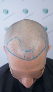 Injerto Capilar Técnica FUE 1916 Grafts (4597 Pelos) 18 DISEÑO LÍNEA INJERTO