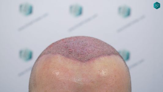Injerto Capilar Técnica FUE 2759 Grafts (6049 Pelos) 14 TRASPLANTE INJERTO CAPILAR