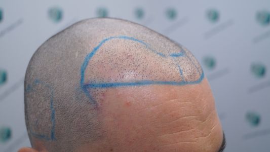 Injerto Capilar Técnica FUE 1916 Grafts (4597 Pelos) 19 DISEÑO LÍNEA INJERTO