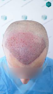 Injerto Capilar Técnica FUE 2759 Grafts (6049 Pelos) 15 TRASPLANTE INJERTO CAPILAR