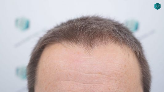 Injerto Capilar Técnica FUE 2759 Grafts (6049 Pelos) 1 Injerto Capilar Técnica FUE 2759 Grafts (6049 Pelos)