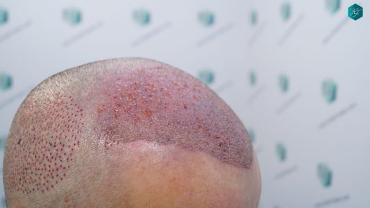 Injerto Capilar Técnica FUE 2759 Grafts (6049 Pelos) 16 TRASPLANTE INJERTO CAPILAR