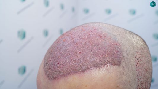 Injerto Capilar Técnica FUE 2759 Grafts (6049 Pelos) 17 TRASPLANTE INJERTO CAPILAR