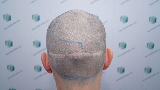 Injerto Capilar Técnica FUE 1916 Grafts (4597 Pelos) 22 DISEÑO LÍNEA INJERTO