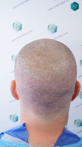 Injerto Capilar Técnica FUE 2759 Grafts (6049 Pelos) 18 TRASPLANTE INJERTO CAPILAR