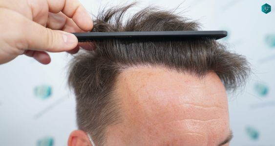 Injerto Capilar Técnica FUE 2759 Grafts (6049 Pelos) 21 RESULTADOS INJERTO CAPILAR EN 12 MESES