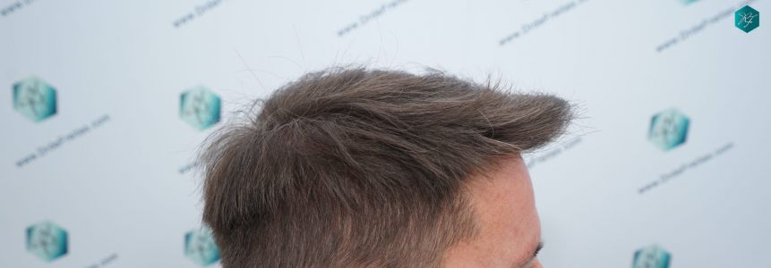 Injerto Capilar Técnica FUE 2759 Grafts (6049 Pelos) 23 RESULTADOS INJERTO CAPILAR EN 12 MESES