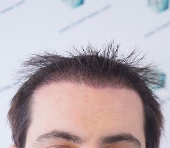 RESULTADOS INJERTO CAPILAR EN 3 MESES RESULTADOS INJERTO CAPILAR EN 3 MESES