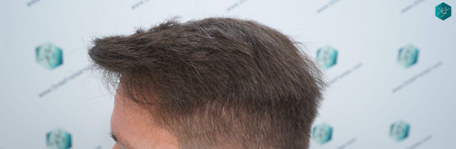 Injerto Capilar Técnica FUE 2759 Grafts (6049 Pelos) 24 RESULTADOS INJERTO CAPILAR EN 12 MESES