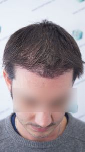 Injerto Capilar Técnica FUE 1916 Grafts (4597 Pelos) 26 RESULTADOS INJERTO CAPILAR EN 3 MESES