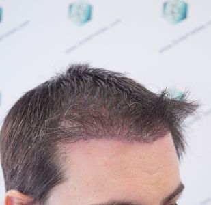 Injerto Capilar Técnica FUE 1916 Grafts (4597 Pelos) 27 RESULTADOS INJERTO CAPILAR EN 3 MESES