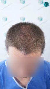 Injerto Capilar Técnica FUE 2759 Grafts (6049 Pelos) 2 Injerto Capilar Técnica FUE 2759 Grafts (6049 Pelos)