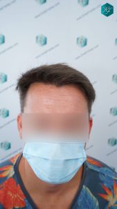 Injerto Capilar Técnica FUE 2759 Grafts (6049 Pelos) 25 RESULTADOS INJERTO CAPILAR EN 12 MESES