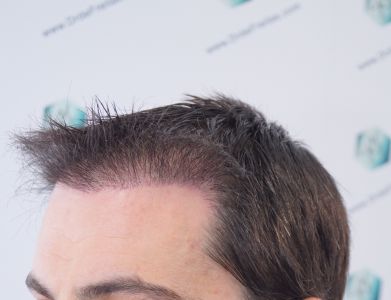 Injerto Capilar Técnica FUE 1916 Grafts (4597 Pelos) 28 RESULTADOS INJERTO CAPILAR EN 3 MESES