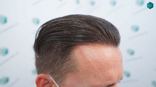 Injerto Capilar Técnica FUE 2759 Grafts (6049 Pelos) 26 RESULTADOS INJERTO CAPILAR EN 12 MESES