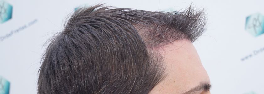 Injerto Capilar Técnica FUE 1916 Grafts (4597 Pelos) 29 RESULTADOS INJERTO CAPILAR EN 3 MESES