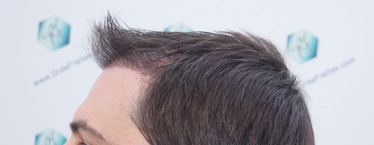 Injerto Capilar Técnica FUE 1916 Grafts (4597 Pelos) 30 RESULTADOS INJERTO CAPILAR EN 3 MESES