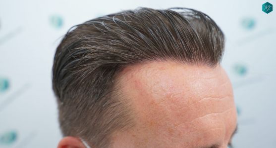Injerto Capilar Técnica FUE 2759 Grafts (6049 Pelos) 27 RESULTADOS INJERTO CAPILAR EN 12 MESES