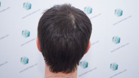 Injerto Capilar Técnica FUE 1916 Grafts (4597 Pelos) 31 RESULTADOS INJERTO CAPILAR EN 3 MESES