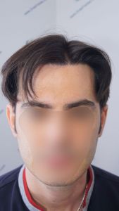 Injerto Capilar Técnica FUE 1916 Grafts (4597 Pelos) 32 RESULTADOS INJERTO CAPILAR EN 12 MESES