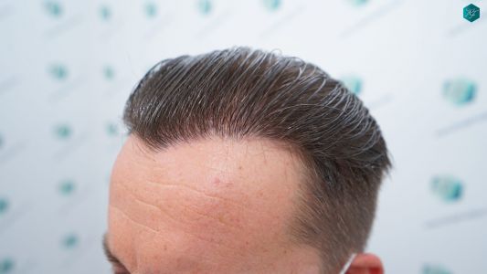 Injerto Capilar Técnica FUE 2759 Grafts (6049 Pelos) 29 RESULTADOS INJERTO CAPILAR EN 12 MESES