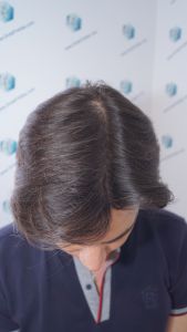 Injerto Capilar Técnica FUE 1916 Grafts (4597 Pelos) 33 RESULTADOS INJERTO CAPILAR EN 12 MESES