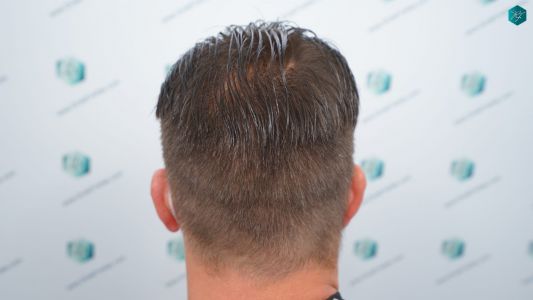 Injerto Capilar Técnica FUE 2759 Grafts (6049 Pelos) 30 RESULTADOS INJERTO CAPILAR EN 12 MESES