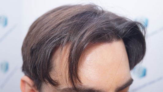 Injerto Capilar Técnica FUE 1916 Grafts (4597 Pelos) 34 RESULTADOS INJERTO CAPILAR EN 12 MESES