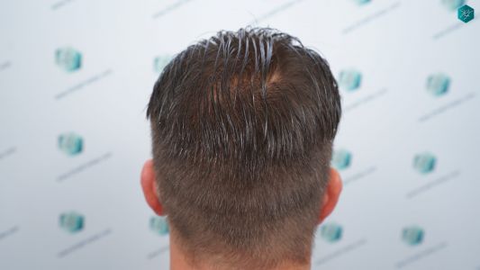 Injerto Capilar Técnica FUE 2759 Grafts (6049 Pelos) 31 RESULTADOS INJERTO CAPILAR EN 12 MESES