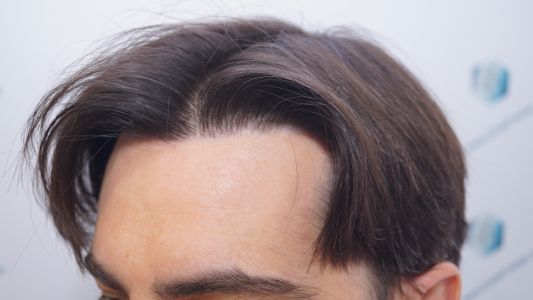 Injerto Capilar Técnica FUE 1916 Grafts (4597 Pelos) 35 RESULTADOS INJERTO CAPILAR EN 12 MESES