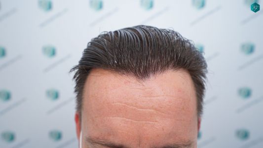 Injerto Capilar Técnica FUE 2759 Grafts (6049 Pelos) 32 RESULTADOS INJERTO CAPILAR EN 12 MESES
