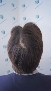 Injerto Capilar Técnica FUE 1916 Grafts (4597 Pelos) 36 RESULTADOS INJERTO CAPILAR EN 12 MESES