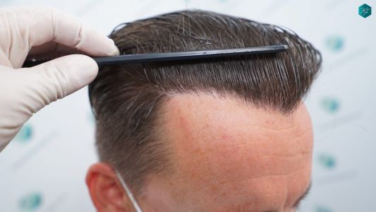 Injerto Capilar Técnica FUE 2759 Grafts (6049 Pelos) 33 RESULTADOS INJERTO CAPILAR EN 12 MESES