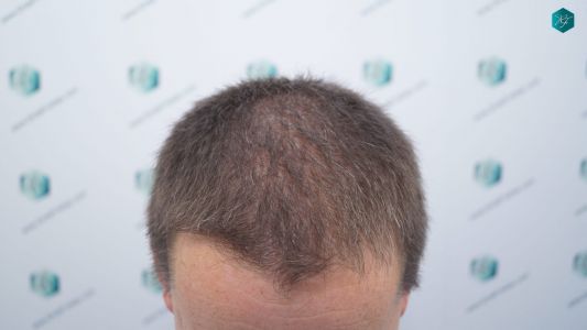 Injerto Capilar Técnica FUE 2759 Grafts (6049 Pelos) 3 Injerto Capilar Técnica FUE 2759 Grafts (6049 Pelos)
