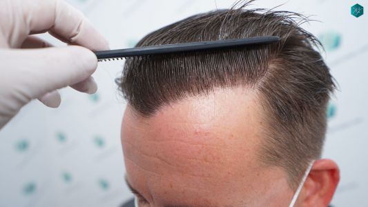 Injerto Capilar Técnica FUE 2759 Grafts (6049 Pelos) 34 RESULTADOS INJERTO CAPILAR EN 12 MESES