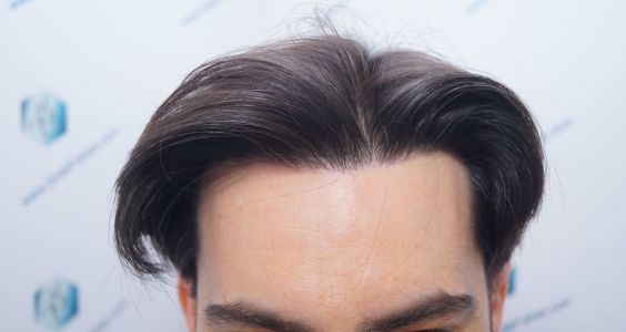 Injerto Capilar Técnica FUE 1916 Grafts (4597 Pelos) 38 RESULTADOS INJERTO CAPILAR EN 12 MESES
