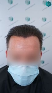 Injerto Capilar Técnica FUE 2759 Grafts (6049 Pelos) 35 RESULTADOS INJERTO CAPILAR EN 12 MESES