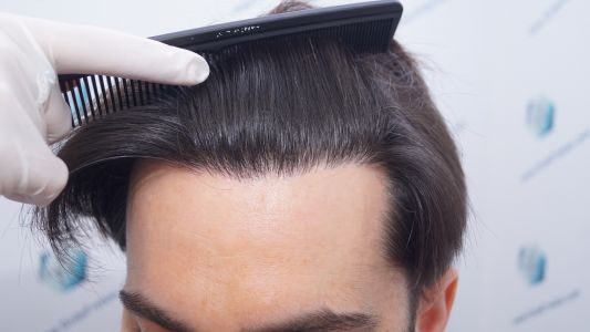 Injerto Capilar Técnica FUE 1916 Grafts (4597 Pelos) 40 RESULTADOS INJERTO CAPILAR EN 12 MESES
