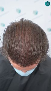 Injerto Capilar Técnica FUE 2759 Grafts (6049 Pelos) 36 RESULTADOS INJERTO CAPILAR EN 12 MESES