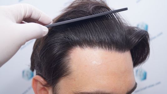 Injerto Capilar Técnica FUE 1916 Grafts (4597 Pelos) 41 RESULTADOS INJERTO CAPILAR EN 12 MESES