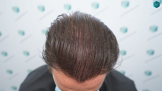 Injerto Capilar Técnica FUE 2759 Grafts (6049 Pelos) 37 RESULTADOS INJERTO CAPILAR EN 12 MESES